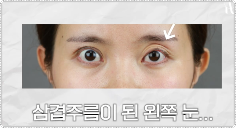 언주역성형외과 쌍꺼풀풀려서 재수술 고민중이라면 관련 이미지 2