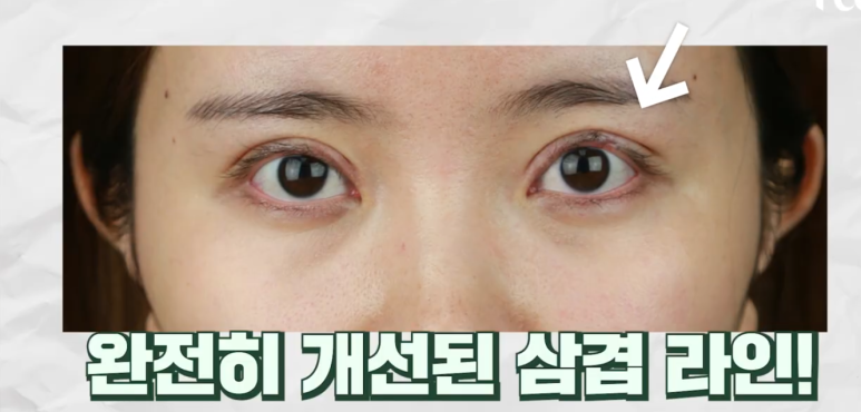 Gangnam Station Double Eyelid Revision Surgery: Let’s Look at Extreme Eye Cases (White-Eyed Appearance, Multiple Fold Creases) image 6