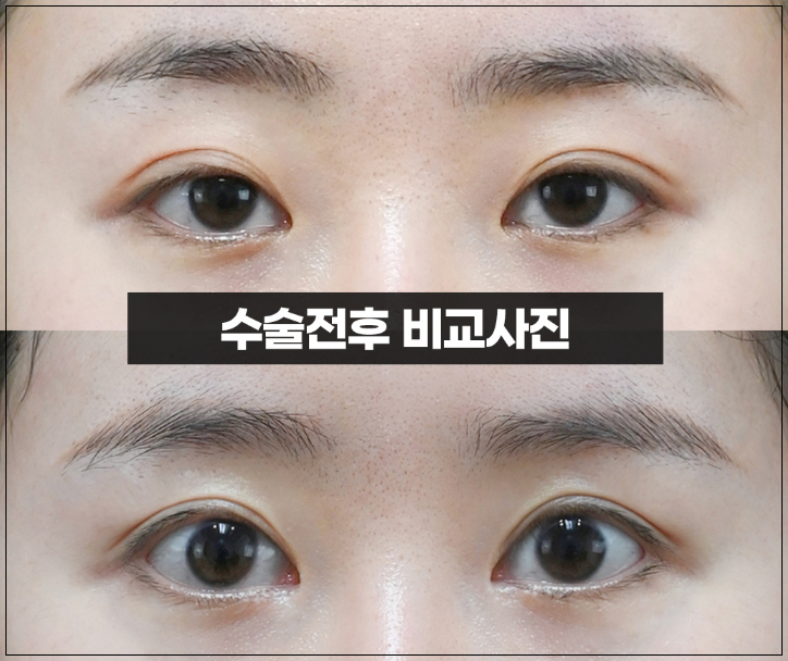 역삼동성형외과 눈재수술과 눈매교정 재수술, 함께 고려해야 하는 이유 관련 이미지 4