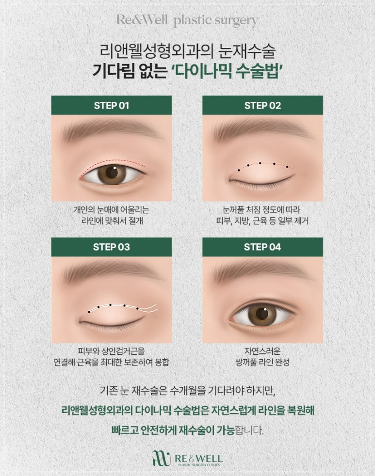 선릉역성형외과, 눈재수술 어떨때 고려하시나요? 관련 이미지 6