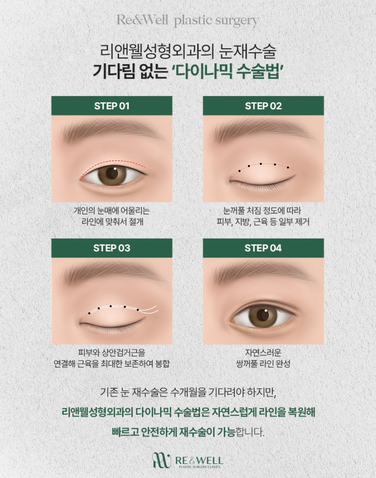 역삼역눈재수술 눈수술 후 후회된다면, 재수술 전에 꼭 읽어보세요 관련 이미지 5