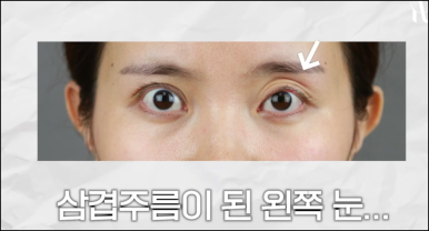 선릉역성형외과 눈재수술 어떤 기준으로 살펴보시나요? 관련 이미지 6