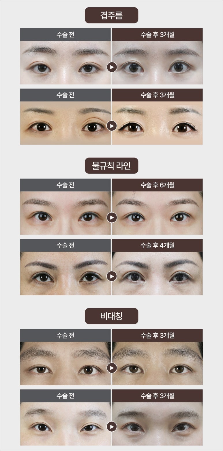 역삼 성형외과, 겹주름, 극한눈으로 눈재수술이 고민이시라면 관련 이미지 8