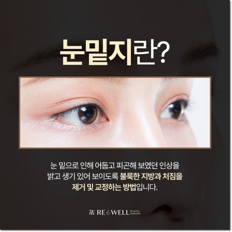 강남역삼동성형외과 눈 밑 변화의 원인부터 살펴봐요 관련 이미지 3