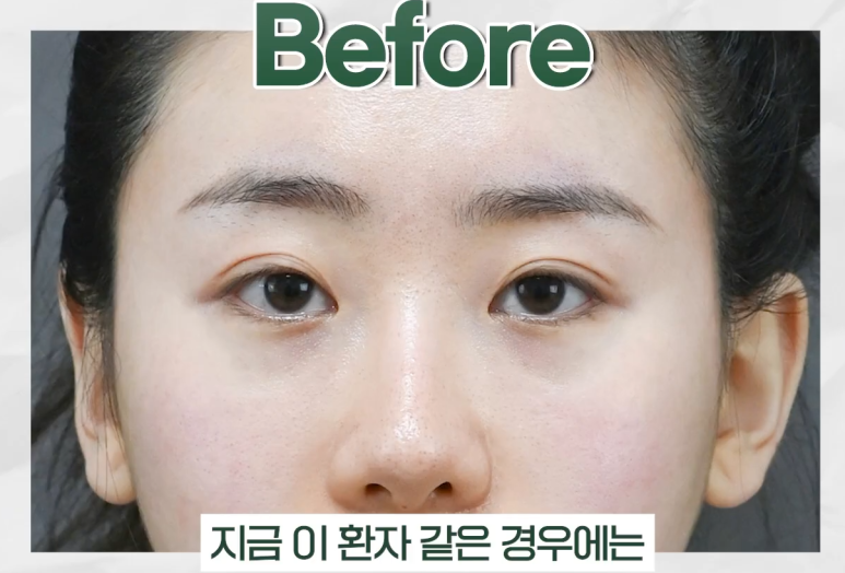 대치동성형외과 눈재수술을 통해 졸린 눈을 또렷한 눈으로 개선하는 과정 관련 이미지 3