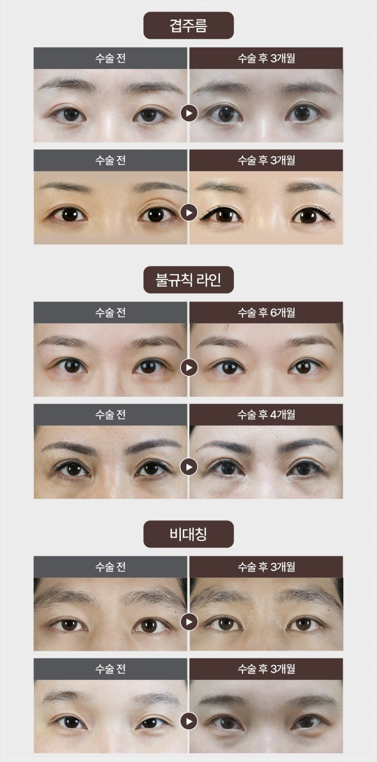 도곡동성형외과 쌍꺼풀 눈재수술 어떤 기준으로 찾고 계신가요? 관련 이미지 5