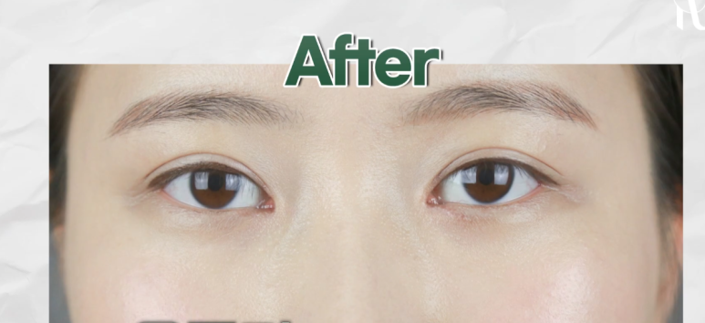 역삼역성형외과, 눈뜨기 힘든 졸린 눈 수술 전후 과정 살펴보기! 관련 이미지 5