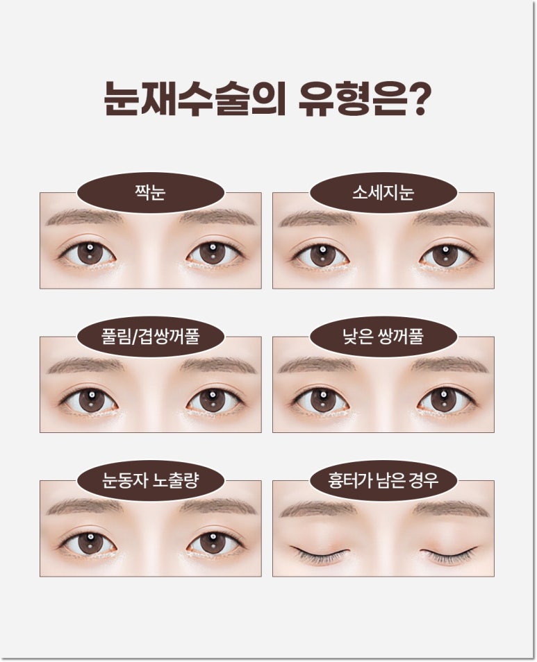 역삼동눈재수술 내 상황에 맞춰서 해요 관련 이미지 5
