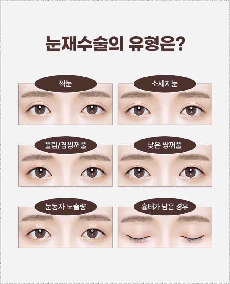 역삼동성형외과 다이나믹 수술법을 통한 눈재수술이란? 관련 이미지 3