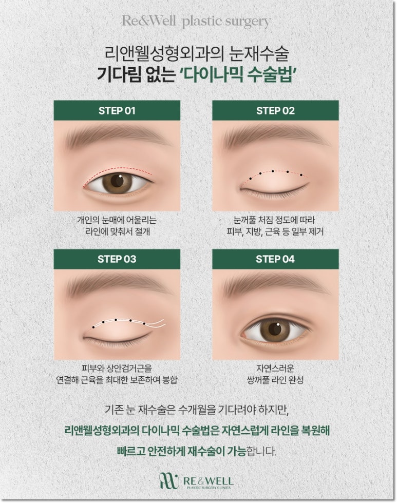 역삼동눈재수술 내 상황에 맞춰서 해요 관련 이미지 6