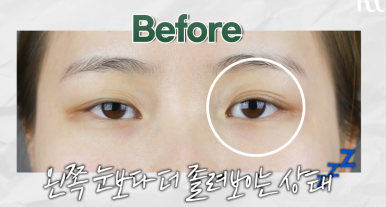 역삼역성형외과, 눈뜨기 힘든 졸린 눈 수술 전후 과정 살펴보기! 관련 이미지 3