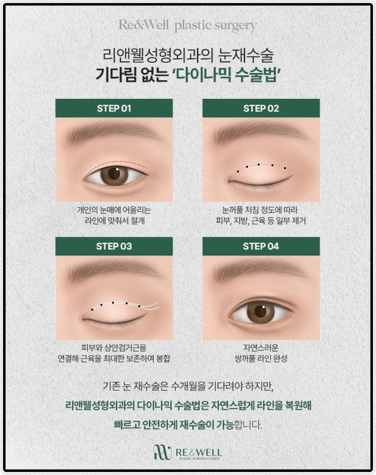 언주역성형외과 쌍꺼풀풀려서 재수술 고민중이라면 관련 이미지 5