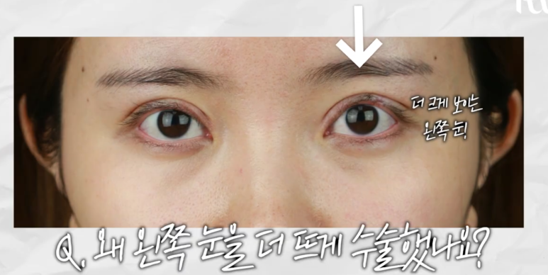 Gangnam Station Double Eyelid Revision Surgery: Let’s Look at Extreme Eye Cases (White-Eyed Appearance, Multiple Fold Creases) image 7