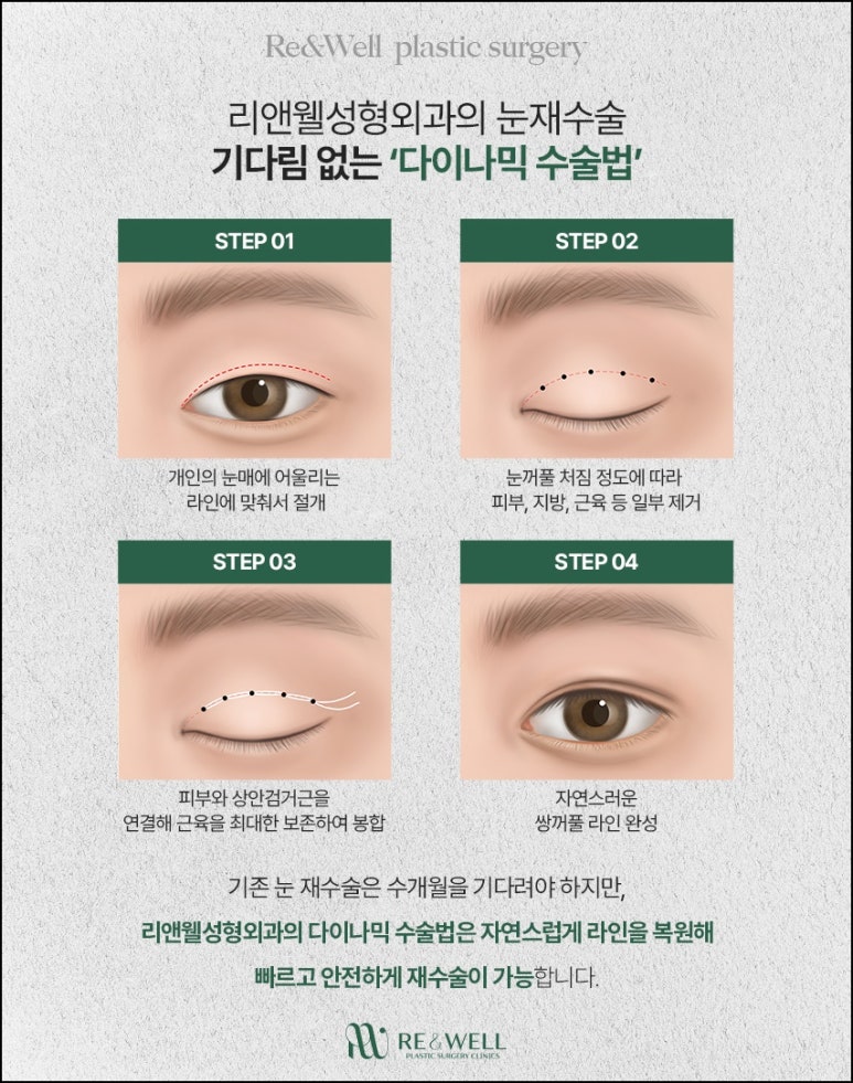 What Is Dynamic Fold Revision Eyelid Surgery with Very Minimal Scarring at Yeoksam-dong Plastic Surgery Clinic? image 4