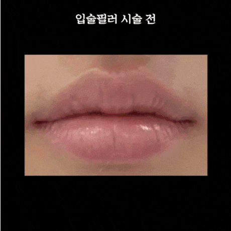 입술필러 1cc 후기, 입꼬리 보톡스와 함께하는 이유 관련 이미지 2