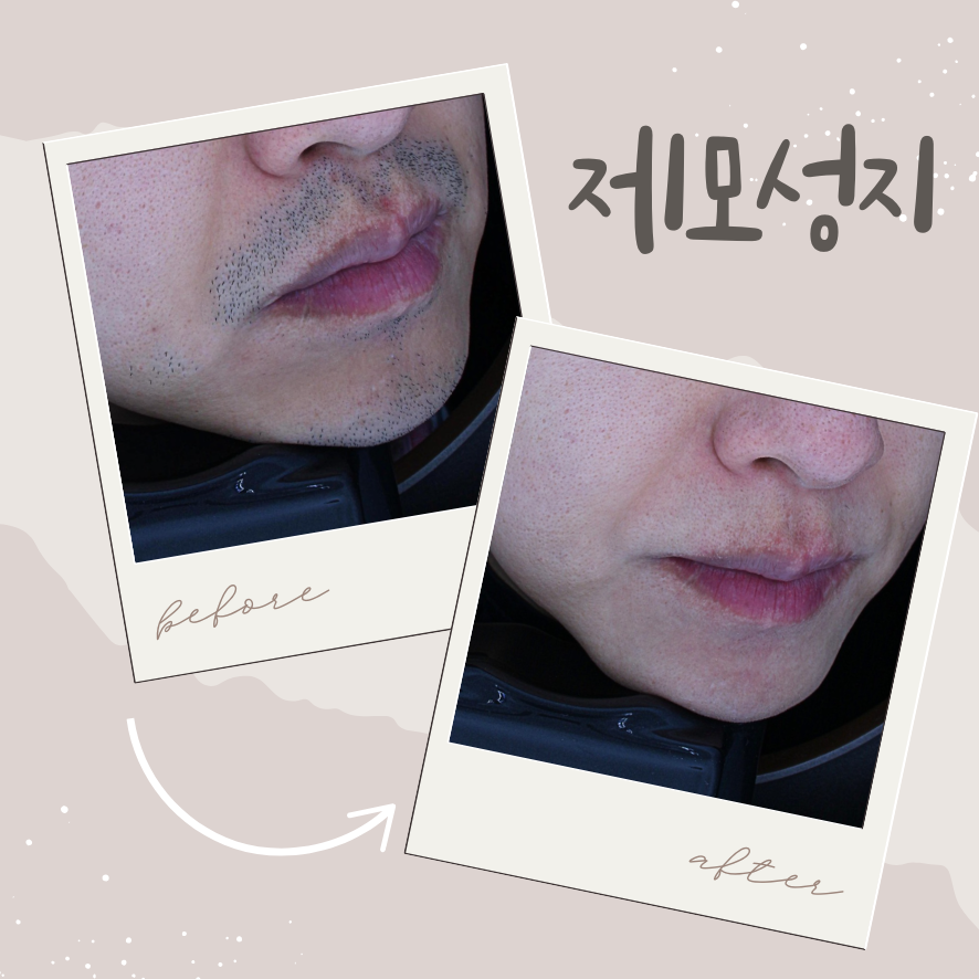 홍대입구역피부과 레이저제모 성지 찾아간 이유 관련 이미지 1