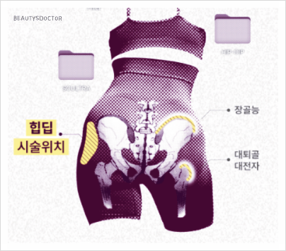힙딥 고민 끝, 필러로 만드는 자연스러운 골반 라인 관련 이미지 2