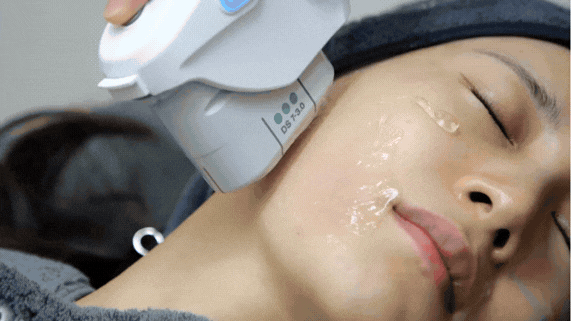 울쎄라 600샷 전후 변화, 이중턱 개선 가능한 이유 관련 이미지 2