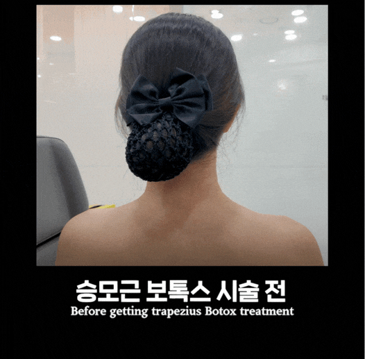 승모근 보톡스, 어깨 뼈 문제가 아니었어요 &mdash; 원장이 직접 설명합니다 관련 이미지 2