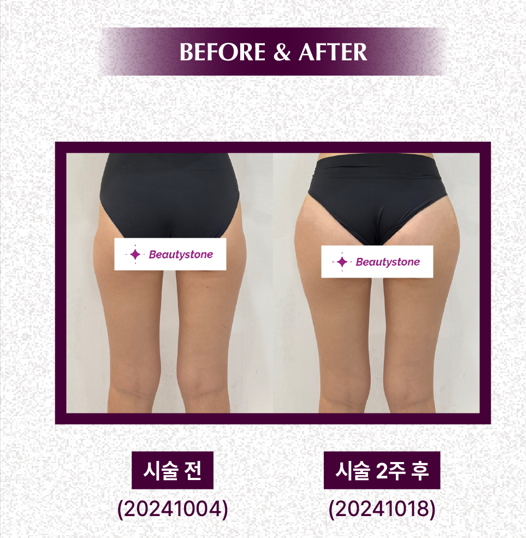 합정 스컬트라 효과 엉덩이, 힙딥에 좋은 이유 관련 이미지 2