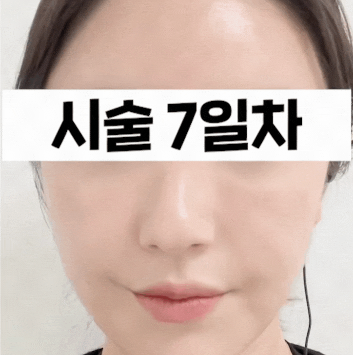 발산역 피부과, 리쥬란 HB 1주간 변화 관련 이미지 4