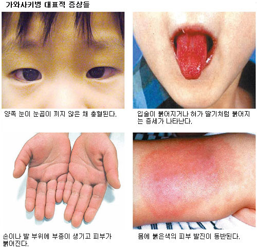영국, 어린이 괴질 속출..증상은 관련 이미지 4
