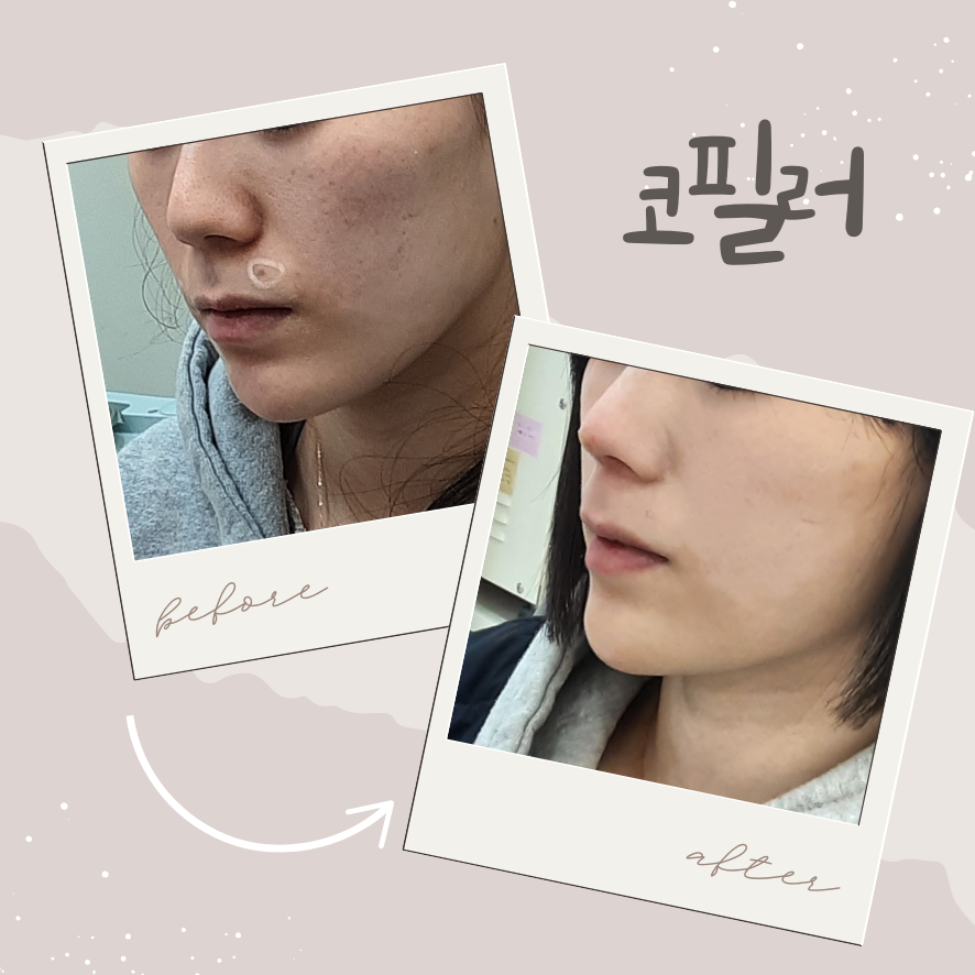 코필러로 어디까지 가능할까요? 낮은 콧대부터 코끝 교정까지 관련 이미지 1