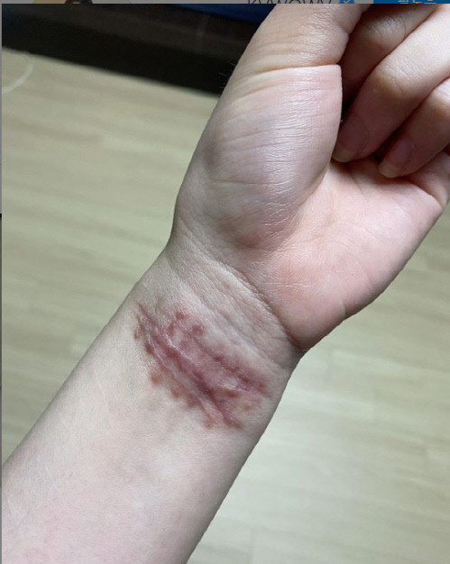 AOA 권민아, 손목 관련 이미지 2