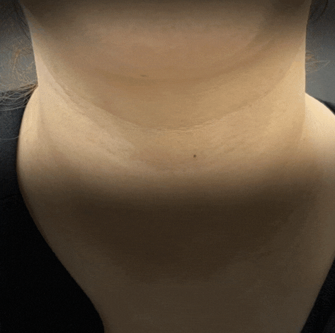 가로 세로목주름 관리법, 목주름 필러 시술 (feat.벨로테로 소프트) 관련 이미지 3