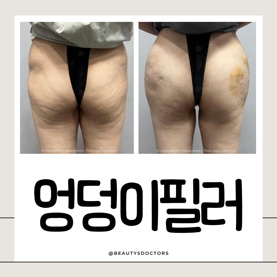 홍대 피부과 힙딥 + 엉덩이 필러로 길어진 다리 라인 관련 이미지 1