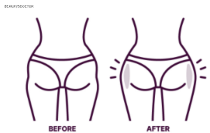 힙딥 고민 끝, 필러로 만드는 자연스러운 골반 라인 관련 이미지 7