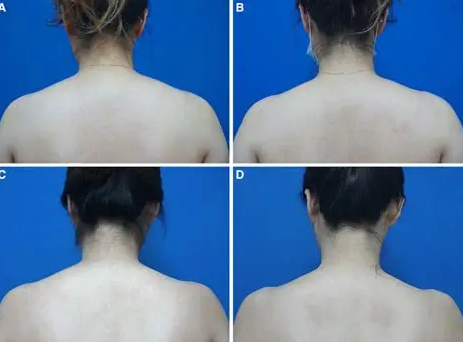 승모근 보톡스, 어깨 뼈 문제가 아니었어요 &mdash; 원장이 직접 설명합니다 관련 이미지 7