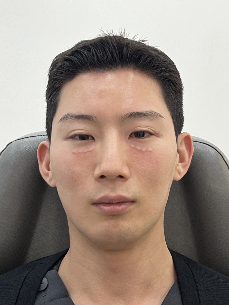 0.5mm 두께의 눈가 피부, 아이크림보다 리쥬란아이가 효율적인 이유 (원장 후기) 관련 이미지 3