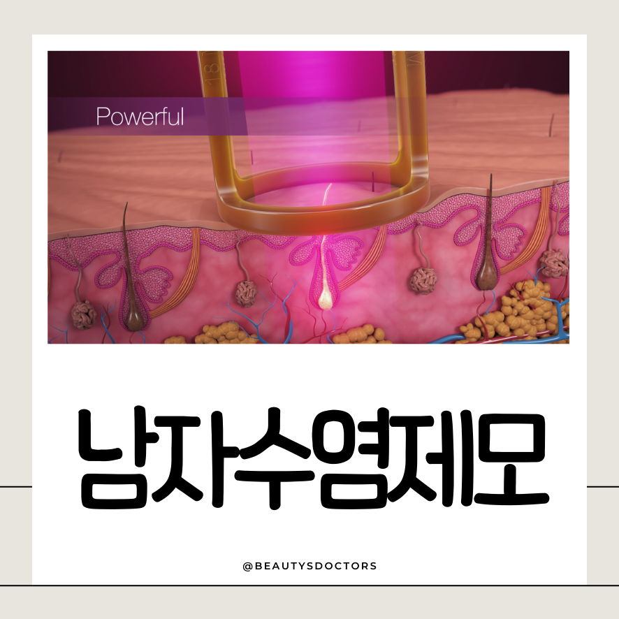 남자수염레이저제모 1회차, 실패없이 받는 법 관련 이미지 1