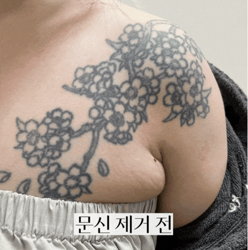 영등포 피부과 문신 제거, 정말 깨끗하게 지워질 수 있을까? 관련 이미지 4