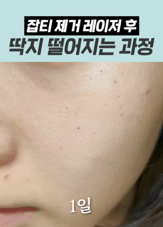 신촌역 피부과 기미&middot;잡티 레이저 제거, 피코토닝 언제가 적기일까 관련 이미지 4