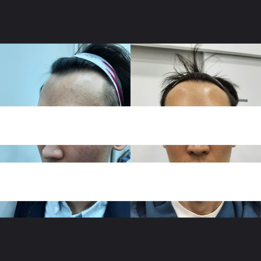 강서구피부과추천 염증주사 후기 관련 이미지 2