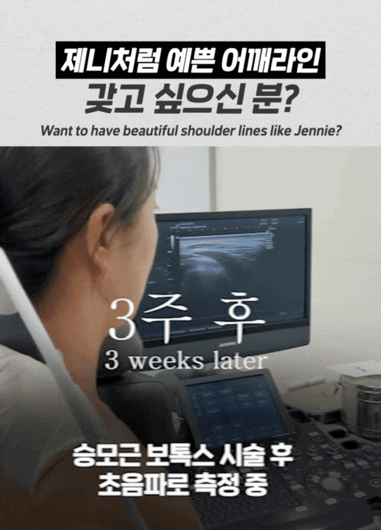 승모근 보톡스 주기와 같이 보는 후기 관련 이미지 2