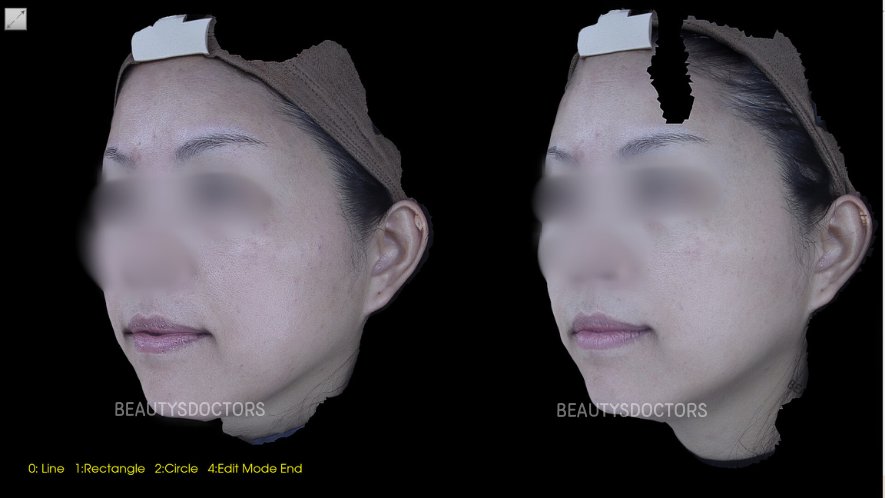 합정 피부과 울써마지 효과 총정리, 가격 비교부터 부작용 체크까지 관련 이미지 3