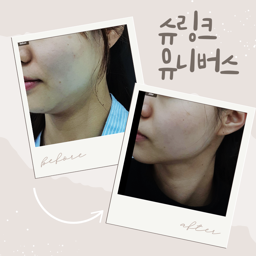 슈링크 유니버스 300샷 효과, 이 정도면 효과 있을까? 관련 이미지 5