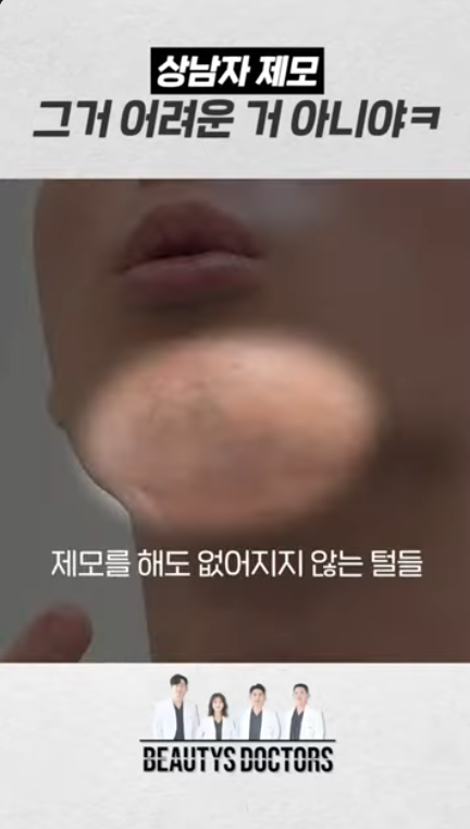 남자 수염 레이저 제모 젠틀맥스프로가 선택되는 이유 관련 이미지 3