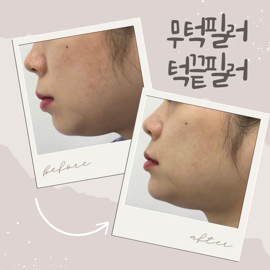 무턱필러/턱끝필러 후기, 만족도 높은 경우의 공통점 관련 이미지 1
