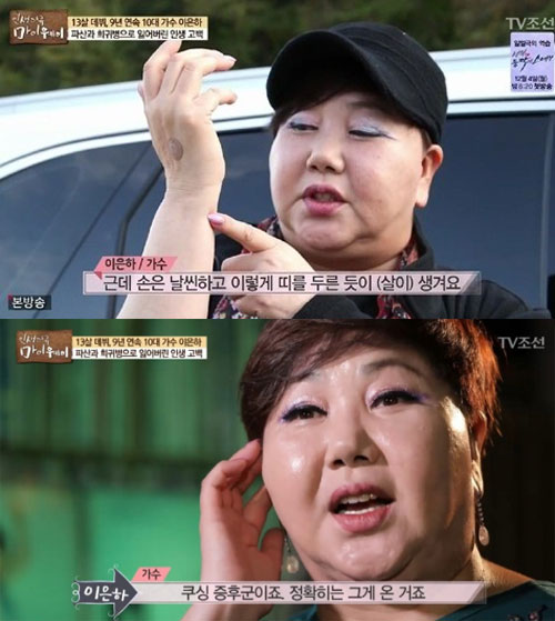 가수 이은하 쿠싱증후군, 급격한 20kg증량 쿠싱증후군 증상과 예방법 관련 이미지 3