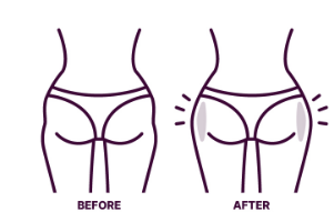 힙딥 필러, 잘하는 곳은 다릅니다 관련 이미지 2