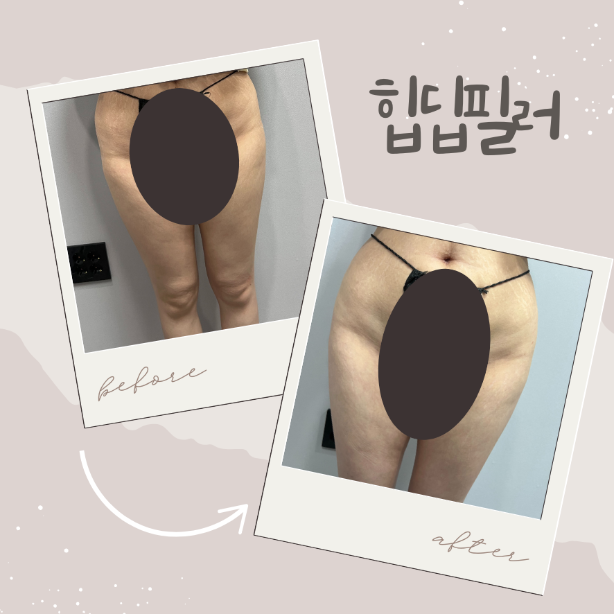 골반필러 잘하는 곳 어떻게 찾을까? 후기 (feat.힙딥필러) 관련 이미지 1