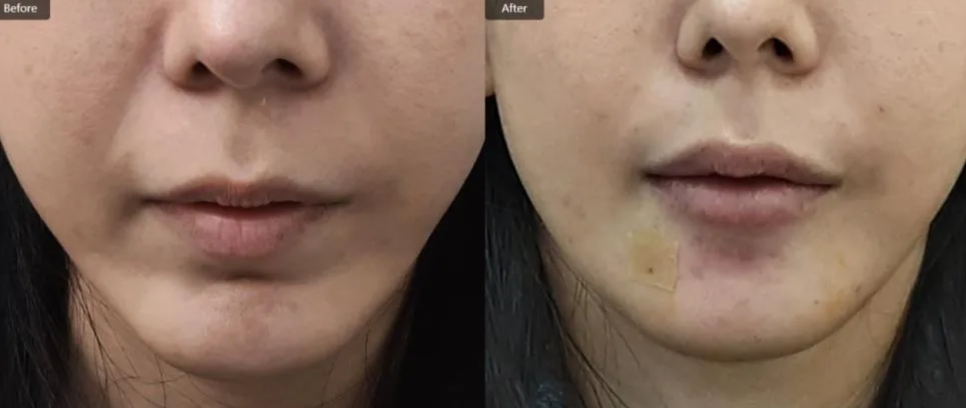 무턱필러/턱끝필러 후기, 만족도 높은 경우의 공통점 관련 이미지 4