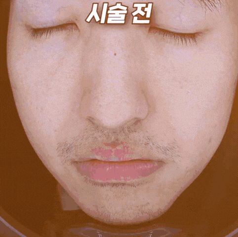 홍대 수염 제모, 젠틀맥스프로플러스로 직접 받아본 후기 관련 이미지 3