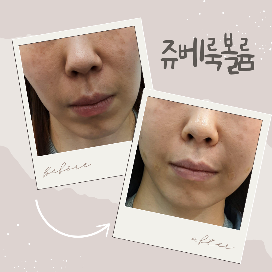 당산역 피부과 쥬베룩 볼륨 효과, 자연스럽게 차오르는 이유 관련 이미지 1