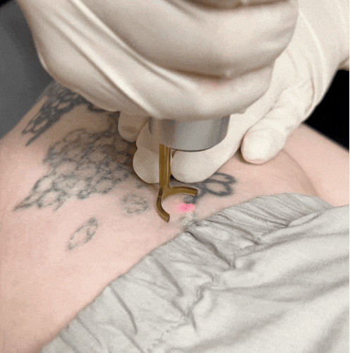 영등포 피부과 문신 제거, 정말 깨끗하게 지워질 수 있을까? 관련 이미지 3