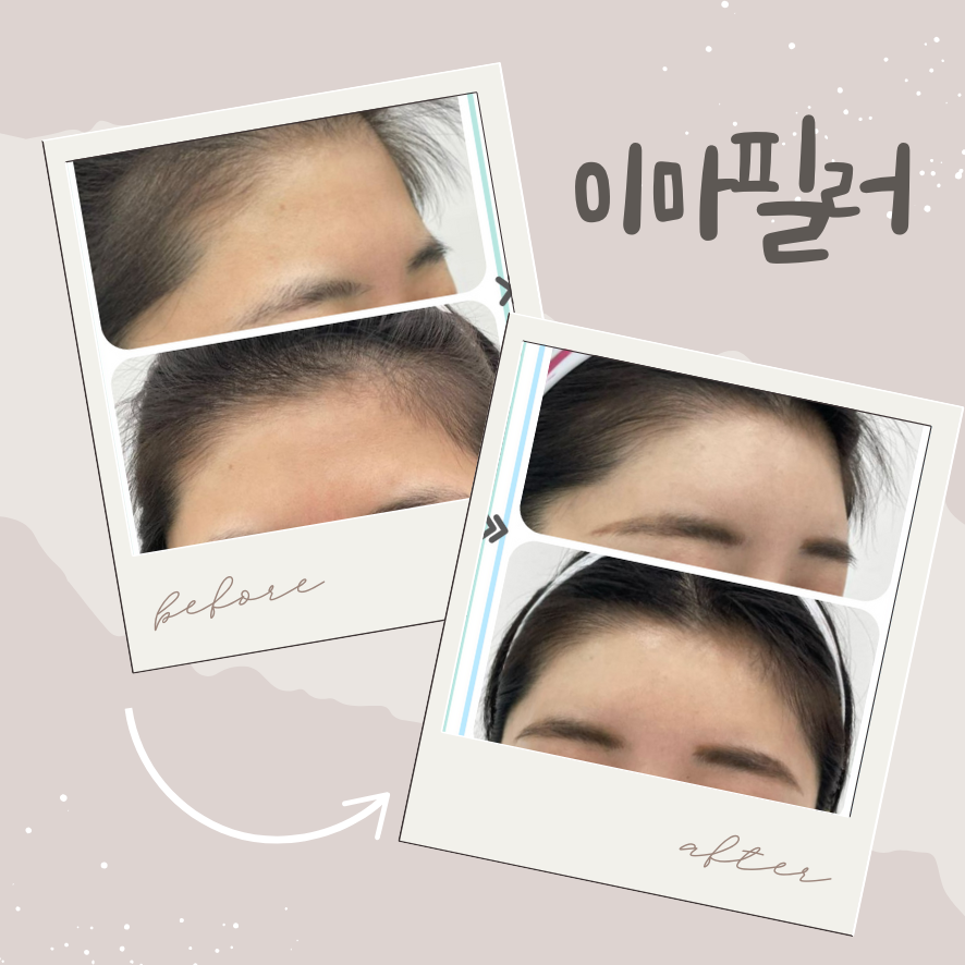 합정 이마필러 후기 속 붓기와 통증, 일상생활 복귀는 언제부터 가능할까? 관련 이미지 1